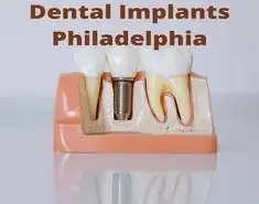 Philadelphia Dental Implants dental implant dentist Philadelphia