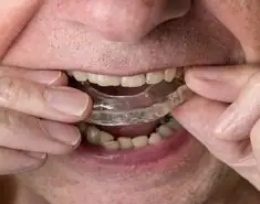 Mouth Guard dental night guard dentist Philadelphia
