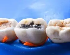Tooth Filling Dentist In Philadelphia Tooth Filling Dentist In Philadelphia
