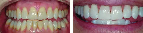 teeth whitening Philadelphia, PA Teeth Whitening Philadelphia, PA