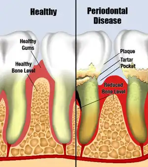 treating gum disease