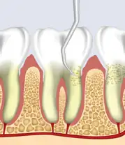 Philadelphia Deep Cleaning Dentist