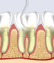 Scaling and Root Planing Dentist In Philadelphia