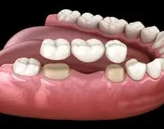 Dental Crowns And Dental Bridges Philadelphia