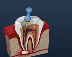 Root Canal Dentist Philadelphia